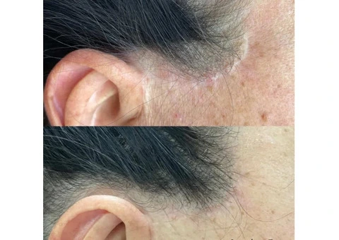 Expert Scar Camouflage Tattoo – Restore Confidence with Belle Clinic