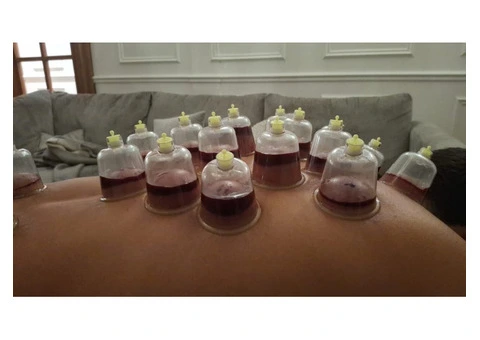 Hijama Cupping Therapy Course – Professional Training - 2/3