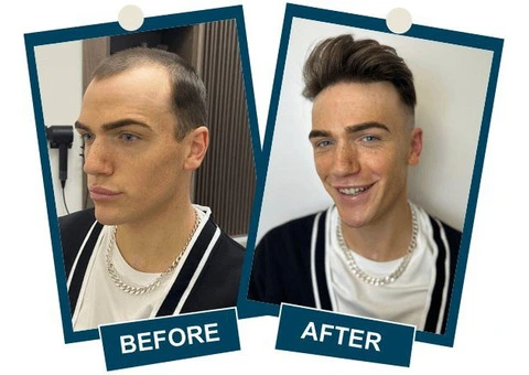 Non-Surgical Hair Loss Treatment in Central London