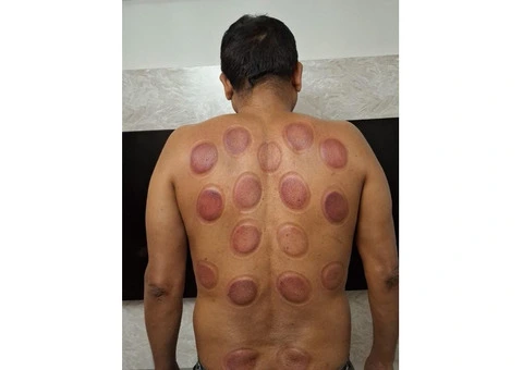 Professional Diploma in Hijama & Cupping Therapy Course - 2/3