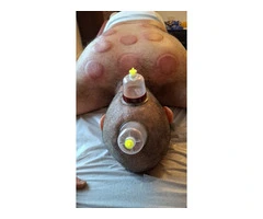 🌙 Sunnah Healing: Hijama Cupping Therapy Course