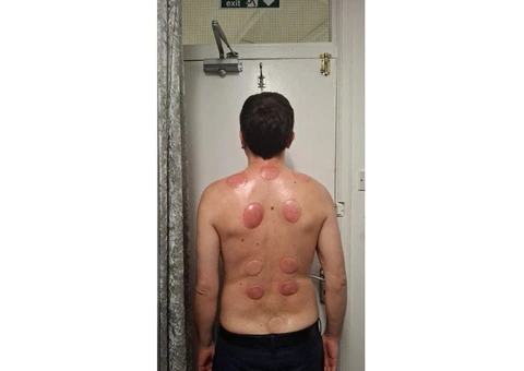 Become a Certified Hijama Therapist - 2/2