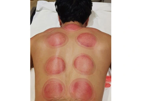 Join London’s Leading Hijama Cupping Training – Enroll Now - 5/5