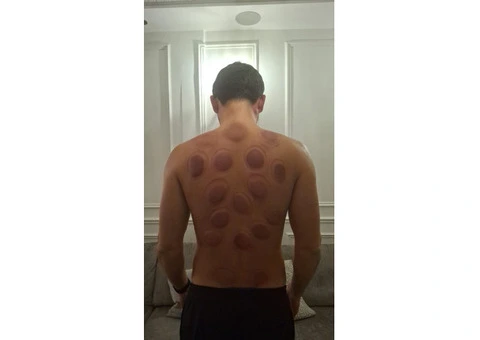 Learn Hijama Cupping Therapy – Hands-On Training & Certification - 1/4