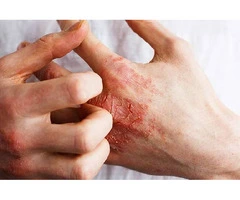 Trusted Legal Help for Occupational Dermatitis Claims in Bolton