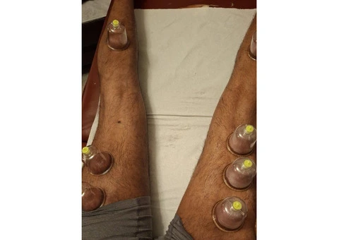 🎓 Certified Hijama Cupping Therapy Course