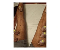 🎓 Certified Hijama Cupping Therapy Course