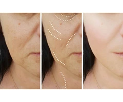 8 Point Facelift London | Non-Surgical Facelift | Liquid Facelift London