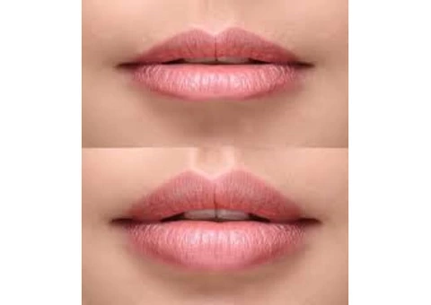 Best Natural Lip Fillers, Lip injections & Lip augmentation in London