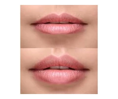 Best Natural Lip Fillers, Lip injections & Lip augmentation in London