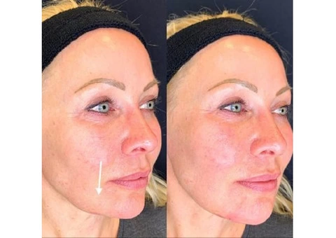 Dermal Fillers in London | Botox and fillers | Restore & Plump Skin