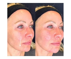 Dermal Fillers in London | Botox and fillers | Restore & Plump Skin