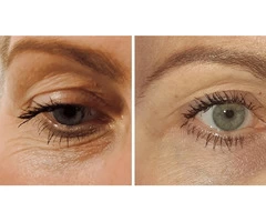 Best Botox London | Anti Wrinkle Injections | Omniya Clinic London