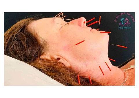 Acupuncture for Women's Health West Sussex