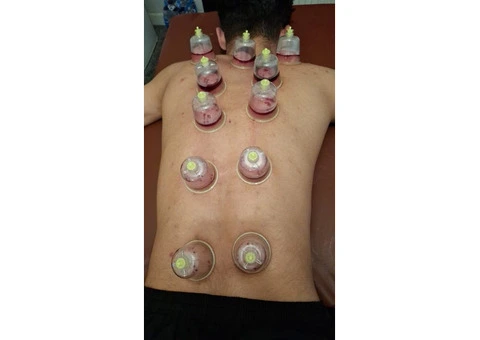 🔥 BECOME A CERTIFIED HIJAMA THERAPIST IN LONDON 🔥