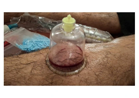 🔥 BECOME A CERTIFIED HIJAMA THERAPIST IN LONDON 🔥 - 2/2
