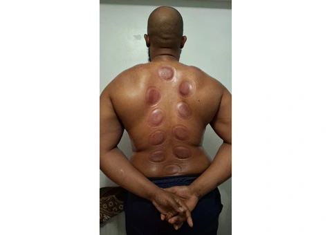 🎓 Professional Hijama Cupping Therapy Course – London - 2/2