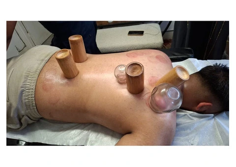 Hijama Cupping Therapy Course in London – Certified Training - 1/3