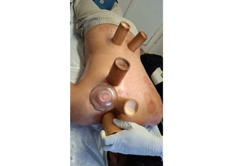 Hijama Cupping Therapy Course in London – Certified Training - 2/3