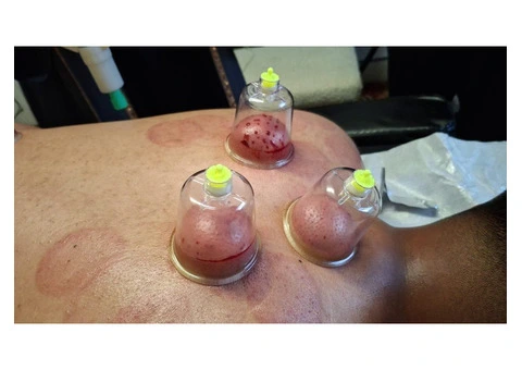 Hijama Cupping Therapy Course in London – Certified Training - 3/3