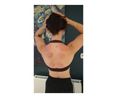Professional Hijama Cupping Course in London | Certified Practical Training