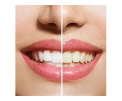 Cosmetic Dentist Bromley for a Brighter Smile