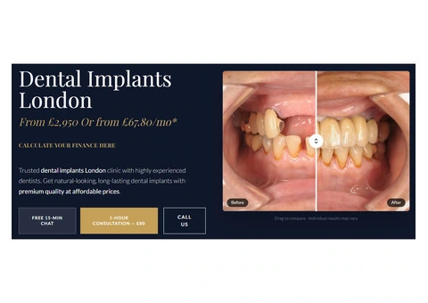 Dental Implants in London | Replace Missing Teeth