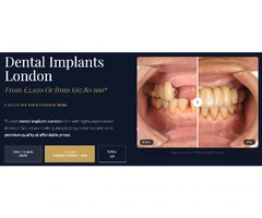 Dental Implants in London | Replace Missing Teeth