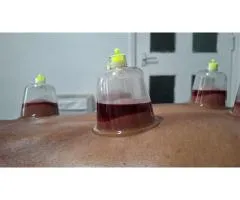 Hijama Course in London | Wet & Dry Cupping Training