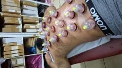 Wet & Dry Cupping Course London