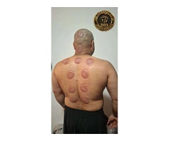 🩸 HIJAMA CUPPING COURSE IN LONDON 🩸