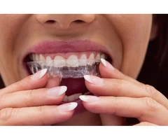 Power of Clear Aligners – Invisalign