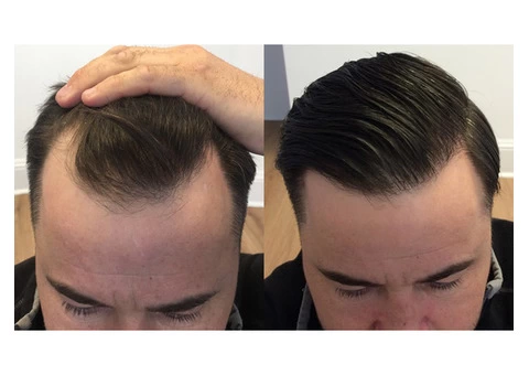 Boost Your Confidence Again With Hair Transplants London