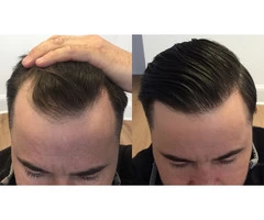 Boost Your Confidence Again With Hair Transplants London