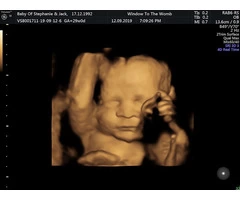 Get a fetal well-being scan in reading from the Window to the Womb.