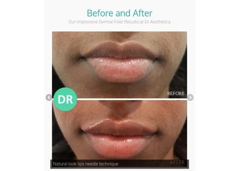 Dermal Fillers Birmingham: Enhance Your Natural Beauty - 2/2