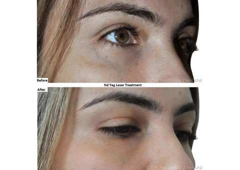 Best ND: YAG Laser Treatment for Skin