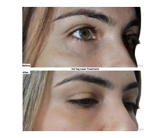 Best ND: YAG Laser Treatment for Skin