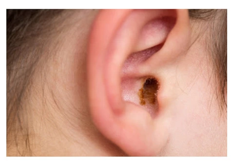 Looking for Ear Wax Removal in Lyne?