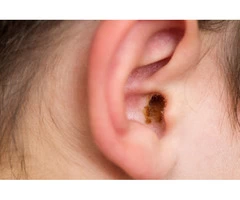 Looking for Ear Wax Removal in Lyne?