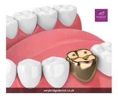 Can I Get A Gold Dental Crown On The NHS?