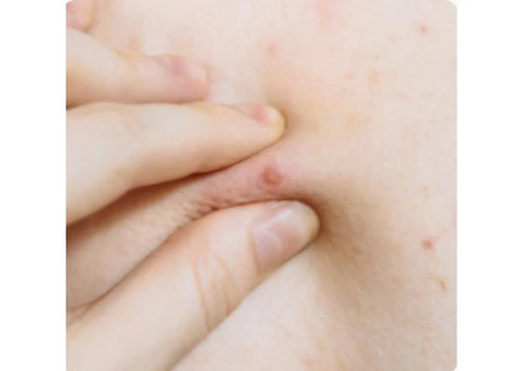 Chest And Back Acne Treatment in Birmingham, UK | Dr Aesthetica Medical Aesthetic Clinic