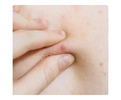 Chest And Back Acne Treatment in Birmingham, UK | Dr Aesthetica Medical Aesthetic Clinic