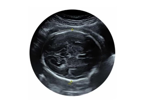 Monitor your pregnancy from the first day with our early pregnancy scan in Reading.