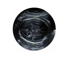 Monitor your pregnancy from the first day with our early pregnancy scan in Reading.