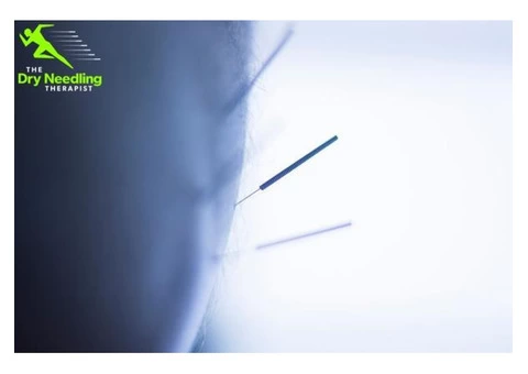 Get Back on the Move with The Dry Needling Therapist