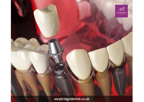 What is a teeth transplantation procedure, and how does it replace a damaged or missing tooth?