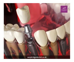 What is a teeth transplantation procedure, and how does it replace a damaged or missing tooth?