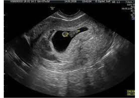 Start your pregnancy journey with our early pregnancy scan in Reading.