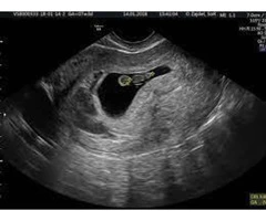 Start your pregnancy journey with our early pregnancy scan in Reading.